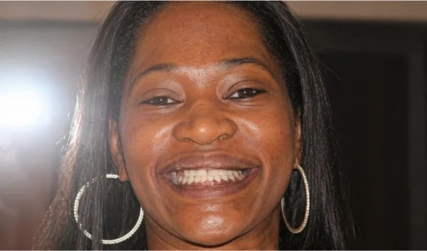 Porcelain veneers beverly hills ca, Dr. Joseph Goodman DDS