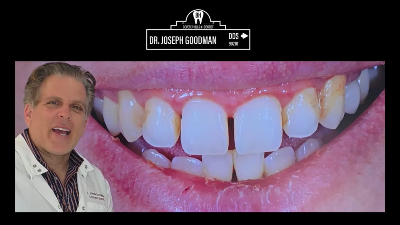 porcelain veneers beverly hills ca, Dr. Joseph Goodman DDS