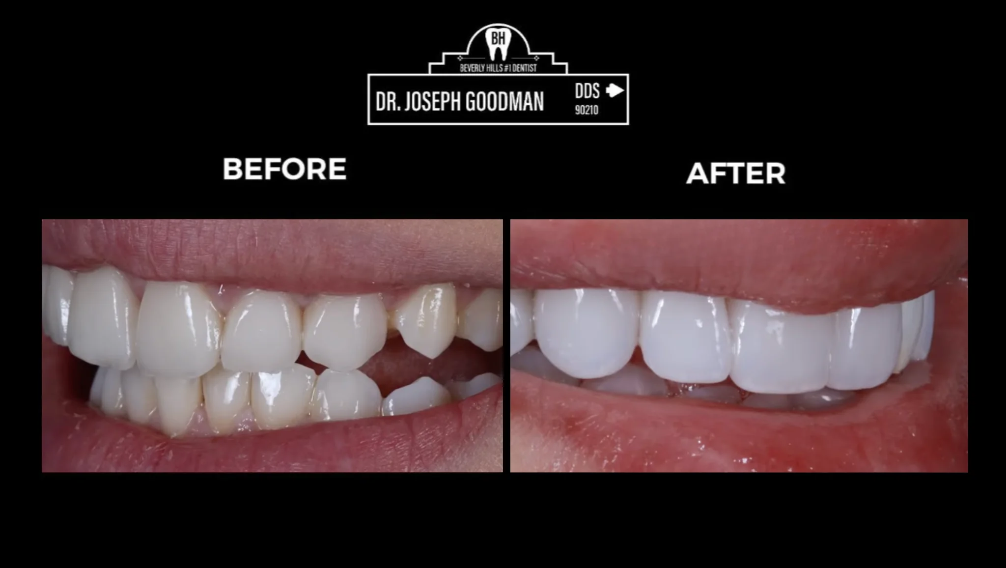 porcelain veneers beverly hills ca, Dr. Joseph Goodman DDS