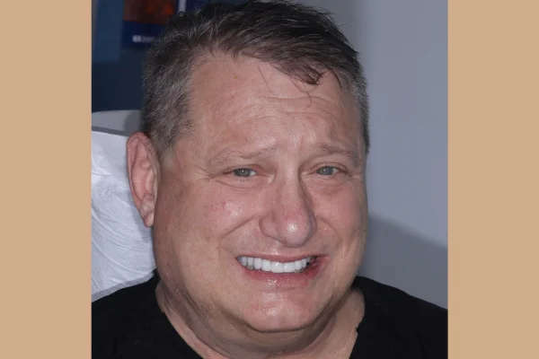under bite beverly hills after with dr. Joseph Goodman