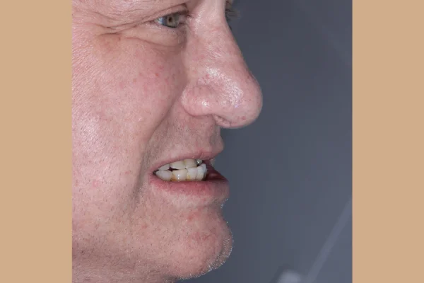 under bite beverly hills before