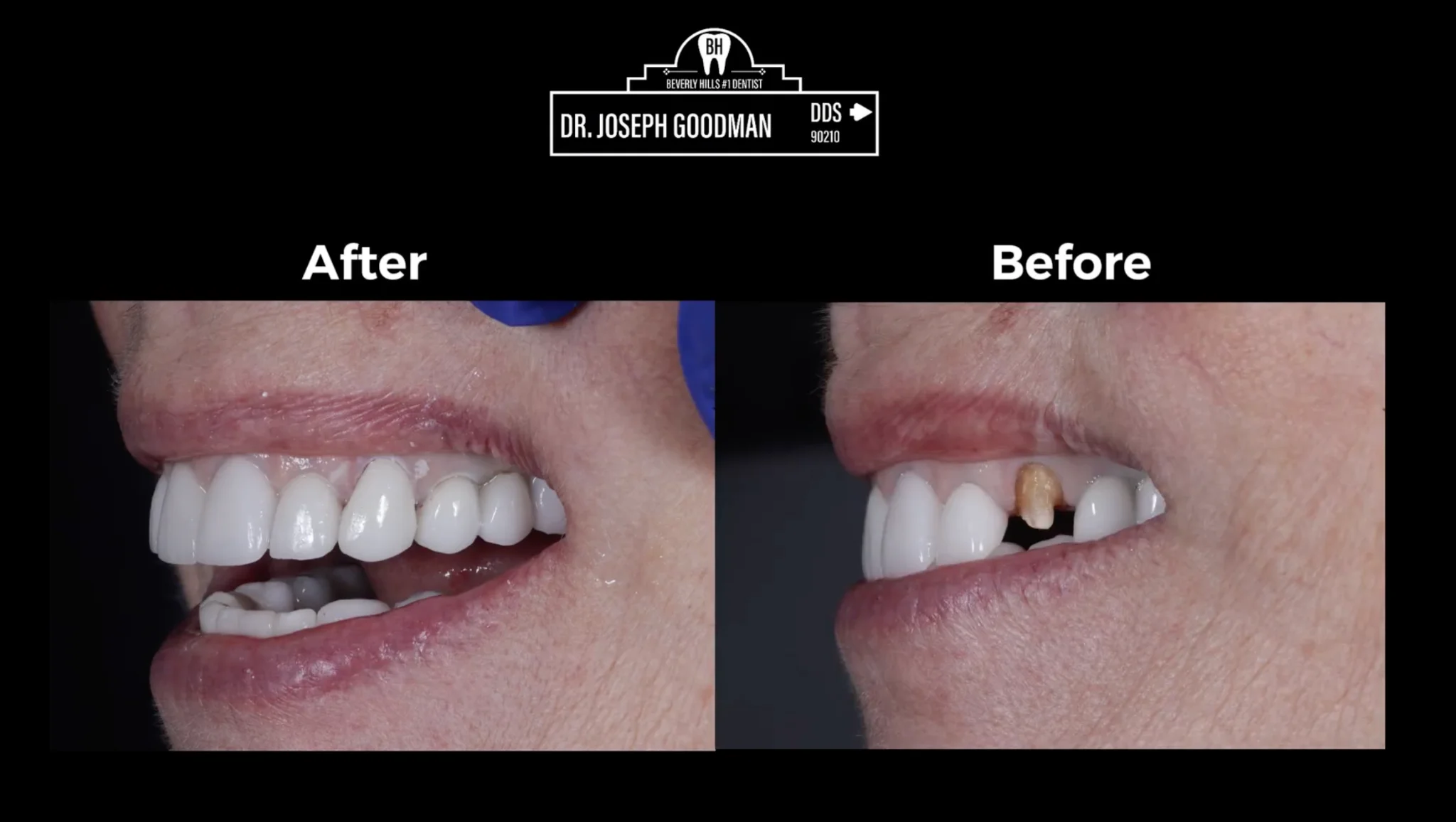 Bad veneers video by Dr. Joseph goodman