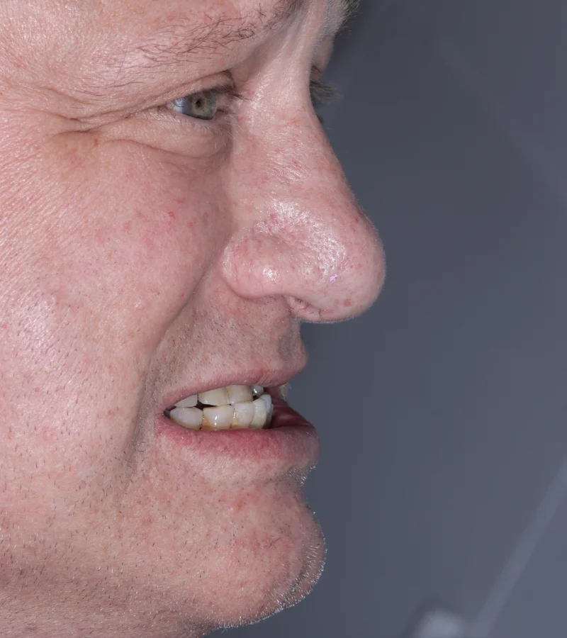 Class 3 bite real patient