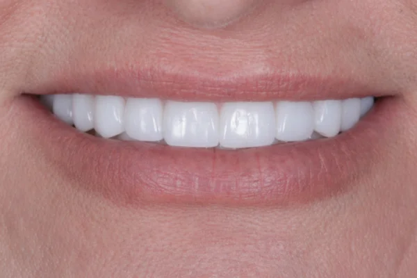 Cross bite beverly hills after fixed with Face Dentistry and Dr. Goodman DDS DMD