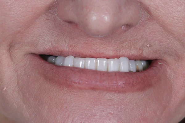 Cross bite beverly hills before fixed with Face Dentistry and Dr. Goodman DDS DMD