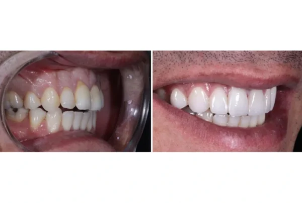 Crossbite correction treatment by Dr. Joseph goodman DDS