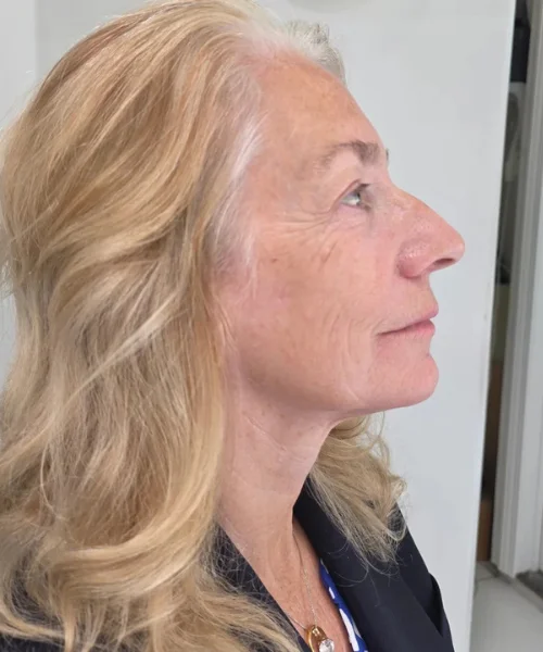 Face Dentistry By Dr. Joseph DDS DMD Beverly Hills CA after treatment