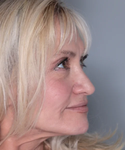 Face Dentistry By Dr. Joseph DDS DMD Beverly Hills CA after 1