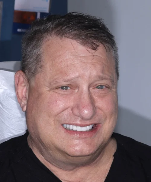 FACE Dentistry • Class III Bite • Underbite • Protruded Chin Anterior Crossbite Facial Profile Correction