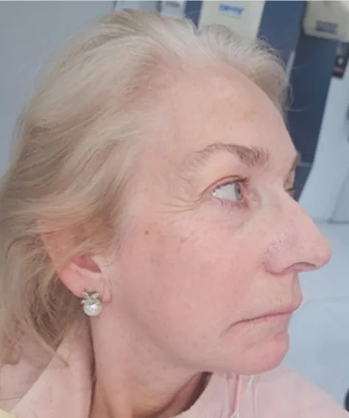 Face Dentistry By Dr. Joseph DDS DMD Beverly Hills CA before treatment