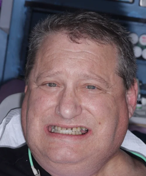 FACE Dentistry • Class III Bite • Underbite • Protruded Chin Anterior Crossbite Facial Profile Correction