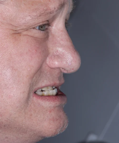 Class III Underbite & Protruded Chin — Non-Surgical Bite Correction FACE Dentistry • Class III Bite • Underbite • Protruded Chin Anterior Crossbite Facial Profile Correction