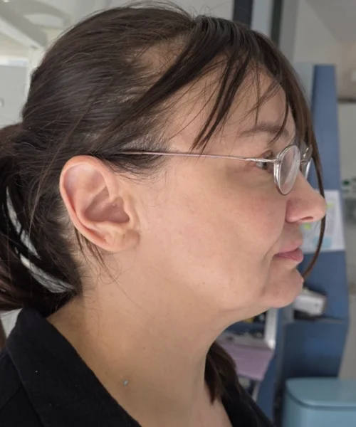Overjet and class 2 correction without small and short chin height. Non-surgical correction without braces or surgery.