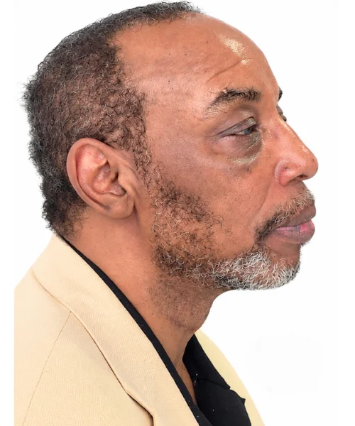 Non-surgical SEVERE CLASS II BITE & RECESSED CHIN CORRECTION