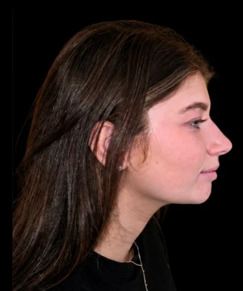 Recessed Chin & Class II Bite Correction Without Jaw Surgery