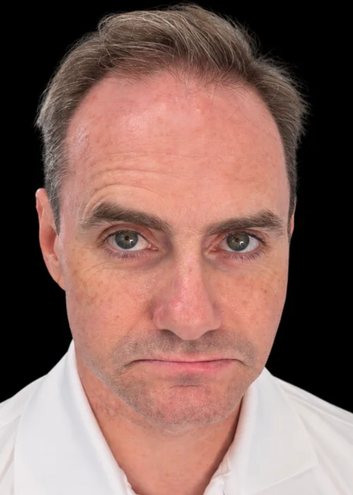 FACE Dentistry: Non-Surgical Facial Profile & Recessed Chin Correction Class II Bite • Short Lower Face • Recessed Chin • Facial Profile Enhancement