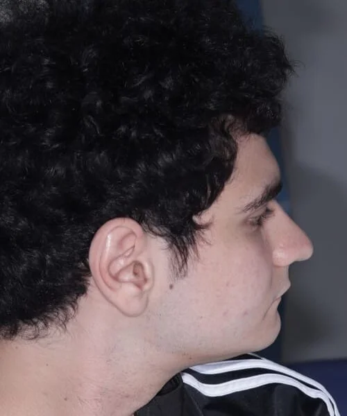 TOP Jaw line is retruded and pushed back