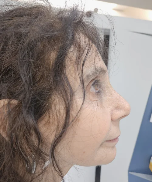 Small Chin Fix with FACE Dentistry