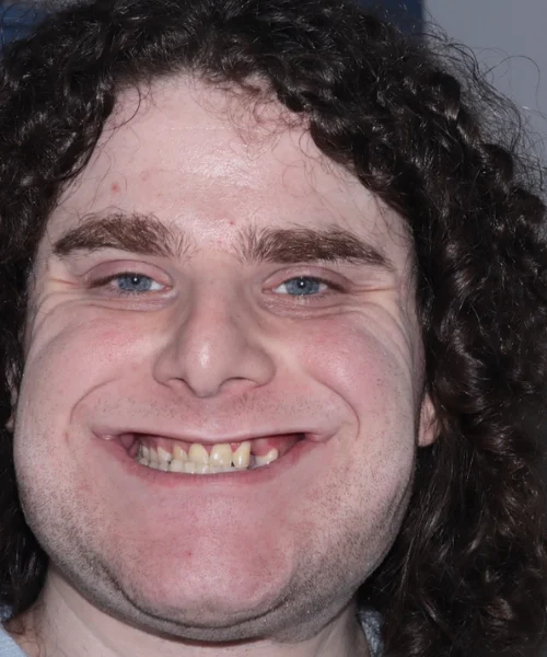 UNDERBITE & CLASS III CORRECTION WITHOUT BRACES OR JAW SURGERY