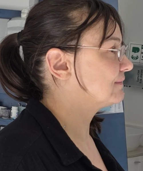 Overjet and class 2 correction without small and short chin height. Non-surgical correction without braces or surgery.