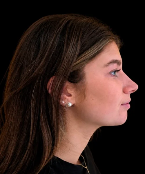 Recessed Chin & Class II Bite Correction Without Jaw Surgery