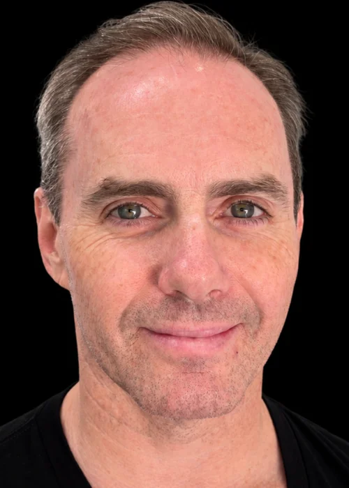 FACE Dentistry: Non-Surgical Facial Profile & Recessed Chin Correction Class II Bite • Short Lower Face • Recessed Chin • Facial Profile Enhancement