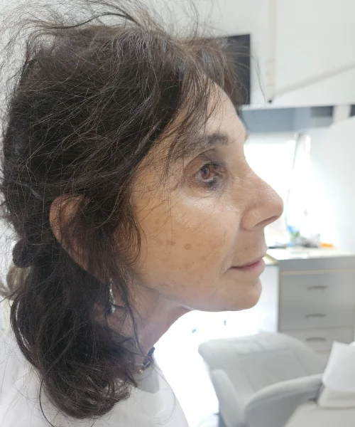 Small Chin Fix with FACE Dentistry