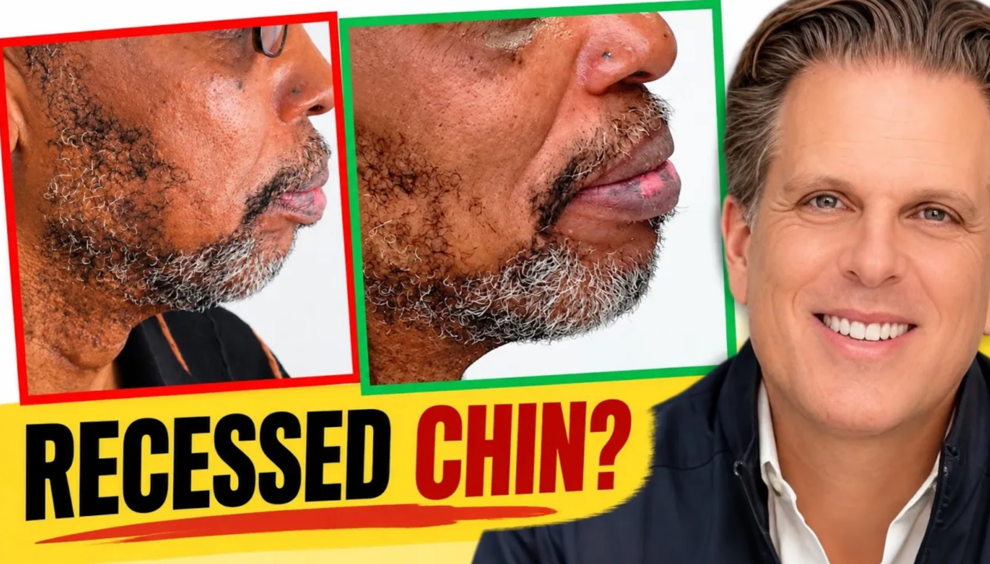 Recessed chin treatment in beverly hills, Dr. Joseph Goodman DDS DMD